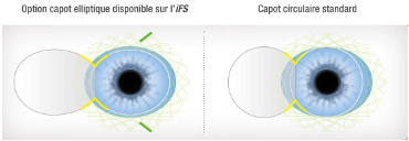 Capot cornéen elliptique de l'IFS 150