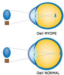 Définition de la myopie