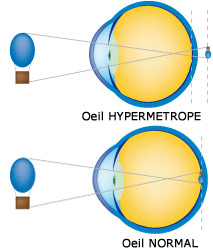 Définition hypermétropie