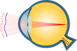 Aberrométrie avant opération des yeux au laser