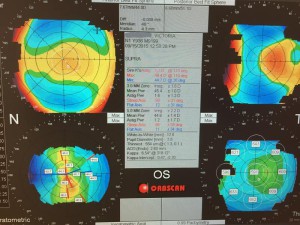 Cartographie de l'oeil par l'Orbscan